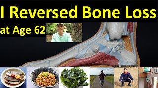 21 Stronger Bones in a Year at 62 Yes Its Possible No Calcium Supplements Needed [upl. by Livvy]