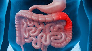 Inflammatory bowel disease  Ulcerative colitis  Weird symptoms amp treatment [upl. by Samara362]