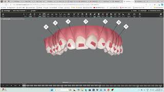 Invisalign  step by step guide [upl. by Joseito]