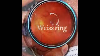 Weiss ring as seen on Indirect ophthalmoscopy shorts [upl. by Cirdes367]