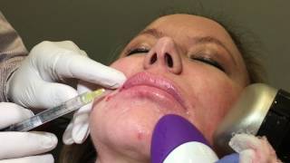 Restylane Refyne Lip Enhancement  Dr Weiner [upl. by Aitnauq]