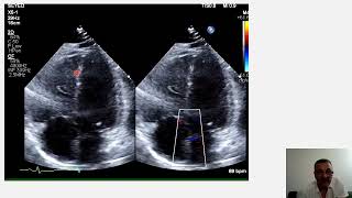 McConnell sign RV strain pulmonary embolism vs RV infarction pulmonary hypertension [upl. by Farman]