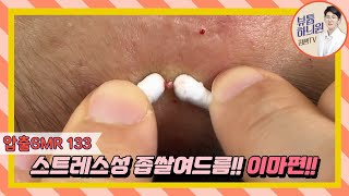 압출SMR 133 스트레스와 수면부족이 좁쌀여드름에 미치는 영향에 대하여 20대 女 [upl. by Aloiv]