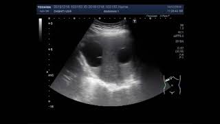 Ultrasound Video showing Hydatid Cysts and a small mass in Liver [upl. by Sorcha366]