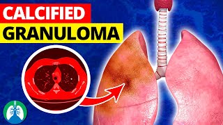 What is a Calcified Granuloma in the Lungs [upl. by Perce]