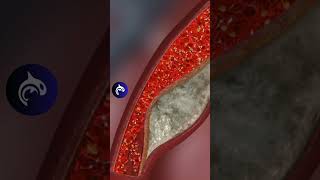 Chest Pain Learn about Angina 🫀 [upl. by Aggarwal3]