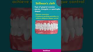 Changes in gingival contour stillmans cleft McCall festoon [upl. by Arhna]