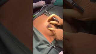 Wide central excision of retroareolar lump [upl. by Hake440]