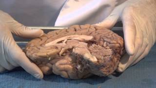 The Ventricles Neuroanatomy Video Lab  Brain Dissections [upl. by Noyes]