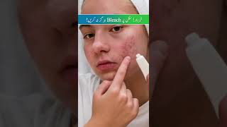 Bleach Burns Redness amp Itching  Tips to Prevent Bleaching BurnsDrUrmila NischalDoctors Circle [upl. by Arlin]