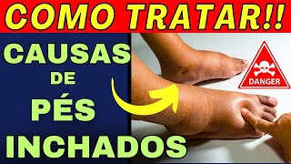 PÉS INCHADOS Causas e tratamentos de inchaço nos pés e pernas  COMO DESINCHAR e melhorar circulação [upl. by Gladstone]