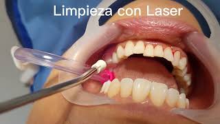 Limpieza Dental con Láser [upl. by Mindy228]