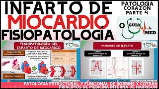 INFARTO AGUDO AL MIOCARDIO FISIOPATOLOGÍA  GuiaMed [upl. by Lundgren]