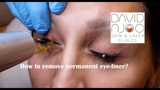 How to remove permanent eye liner using the Picoway laser [upl. by Anna867]