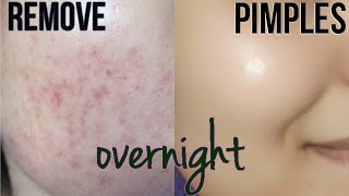 How To Remove Pimples Overnight  Acne Scar Treatment [upl. by Anitac]