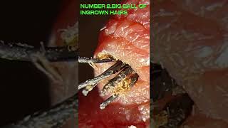 top 5 ingrown hair Super Fast [upl. by Netsua]