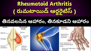 Rheumatoid Arthritis Diet in Telugu రుమటాయిడ్ ఆర్థరైటిస్ ఉన్న వారు తీసుకోవాల్సిన తినకూడని ఆహారం [upl. by Ivatts588]