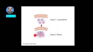 TUBERCULOUS LYMPHADENITIS SCROFULA [upl. by Sefton151]