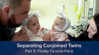 Separating Conjoined Twins Part 5 Finally FacetoFace [upl. by Ertsevlis]