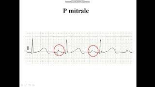 Pmitrale  Diagnosis of LAE [upl. by Swetiana]