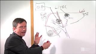 Liver Resection amp Microwave Ablation Procedures  Roswell Park Patient Education [upl. by Adabelle903]