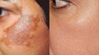 How To Use Potato To Treat Skin Pigmentation Dark Spots Acne Scars Easily At Home  Home Remedies [upl. by Cate66]