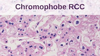 Chromophobe Renal Cell Carcinoma [upl. by Killarney381]