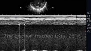 dilated cardiomyopathy [upl. by Aniara339]