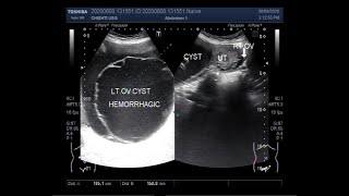 Ultrasound Video showing a Large Ovarian Multiseptated cyst [upl. by Ahsratan213]