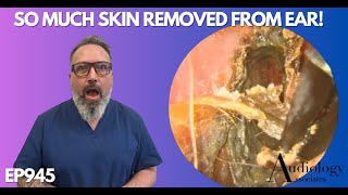 SO MUCH SKIN REMOVED FROM PATIENTS EAR CANAL  EP945 [upl. by Nikita939]