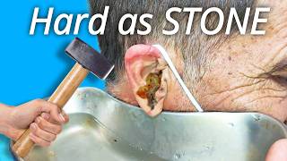 Another level of Ear Wax Cleaning earwaxremoval earcleaning satisfying [upl. by Aidne]