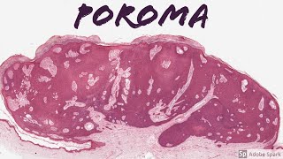 Poroma 5Minute Pathology Pearls [upl. by Enyawud]