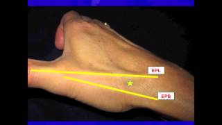 Thumb CarpalMetacarpal CMC Joint injection [upl. by Meri]