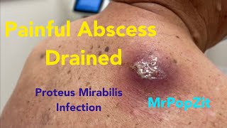 Painful large abscess infected with Proteus Mirabilis drainedCyst contents start at 1410 Amazing [upl. by Arvad]