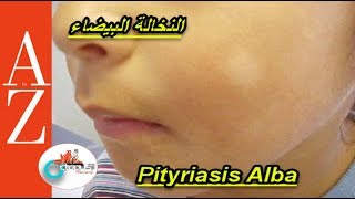 Pityriasis alba  From A to Z  النخالة البيضاء  اسبابها  أعراضها  طرق العلاج والوقاية [upl. by Strickman]