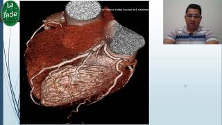 Angiotomografia de coronárias [upl. by Dibri]