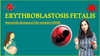 ERYTHROBLASTOSIS FETALIS II Hemolytic disease of the newborn HDN [upl. by Aciret]