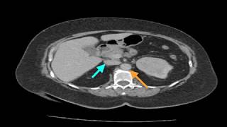 Clinical Case Renal Cell Carcinoma [upl. by Aneelak483]