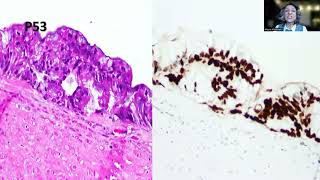 Tip82 Highgrade Appendiceal Mucinous Neoplasm [upl. by Tillfourd]