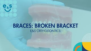 Braces Managing Broken Brackets [upl. by Terryn855]