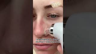 electric blackhead remover 1080p [upl. by Tomasina]