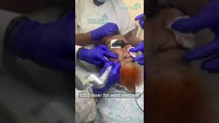 CO2 Laser  Wart Removal  Dhaka Dermatology Institute  LaserTreat [upl. by Benoit]