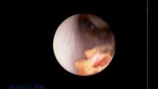 Ureteroscopy and laser fragmentation of stone [upl. by Ji611]