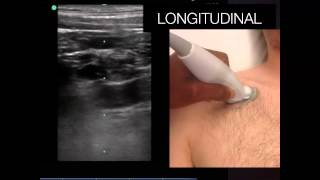 Tutorial Ultrasound Guided Subclavian Line [upl. by Mcwilliams]