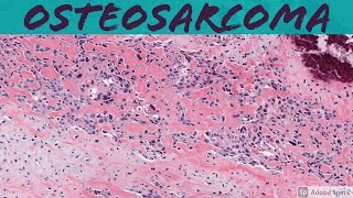 Osteosarcoma 101 Bone Pathology Basics [upl. by Kriste]