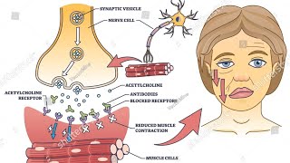 Myasthenia Gravis  the effects [upl. by Skip169]