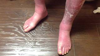 Walters Neuropathy and Edema Laser Therapy Relief Part 1 [upl. by Nassah]