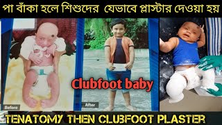 Clubfoot baby Tenatomy জন্মগত পা বাঁকা শিশুOur Treatment [upl. by Lloyd814]