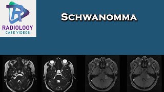 Left CP angle Schwannoma causing Trigeminal Neuralgia [upl. by Samoht233]