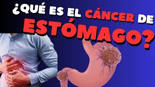 ¿Qué es el cáncer de estómago [upl. by Thaxter762]